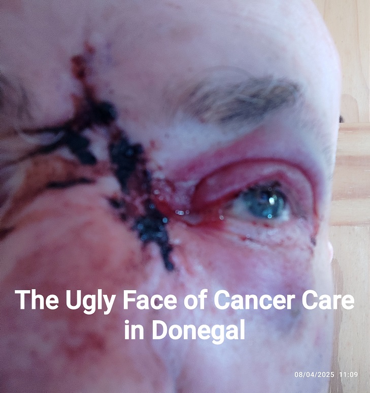 The Ugly Face of Cancer Care in Donegal